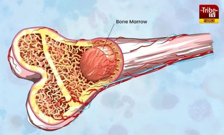 Bone marrow transplant