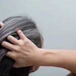 Premature Greying of Hair